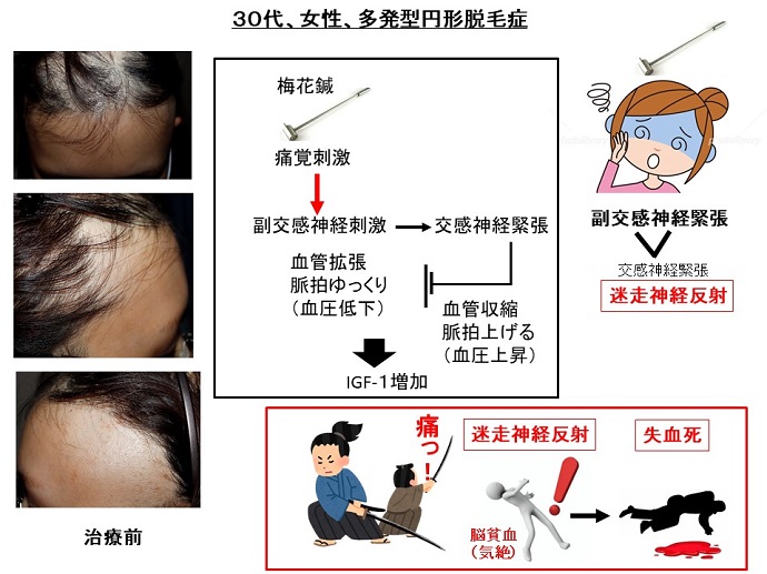 円形脱毛症　病院